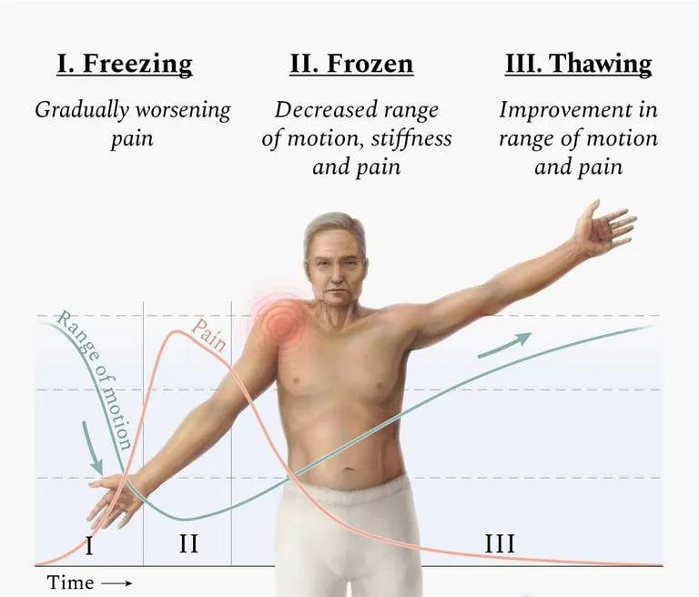 3 Main stages of Frozen Shoulder 3 Main stages of Frozen Shoulder